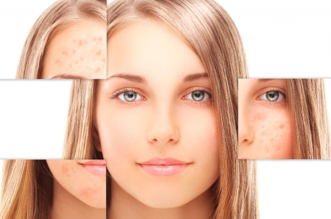 Graus De Acne Entenda Os Diferentes Tipos De Tratamento Drogarias